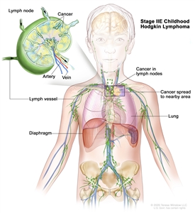 Stage IIE childhood Hodgkin lymphoma; drawing shows cancer in one lymph node group above the diaphragm and in the left lung. An inset shows a lymph node with a lymph vessel, an artery, and a vein. Lymphoma cells containing cancer are shown in the lymph node.